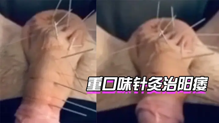 针灸治阳痿你想试下吗